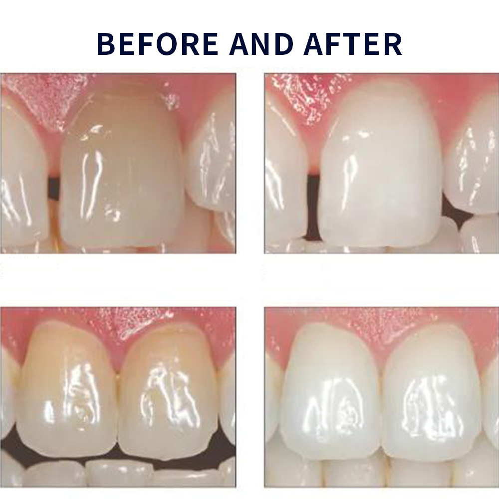 Opalescence Whitening 20% PF 2 - Teeth Whitening At Home Kit ulasan dan harga