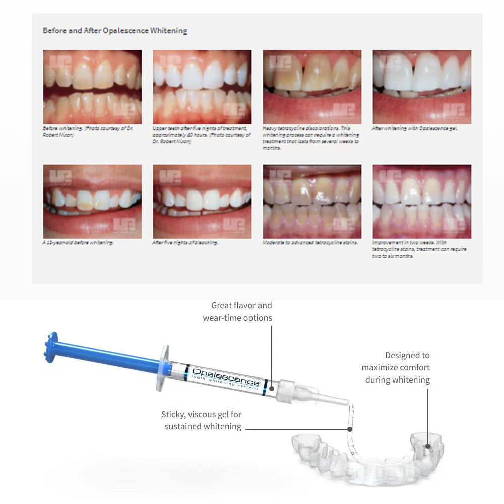 Opalescence Whitening 20% PF 2 - Teeth Whitening At Home Kit ulasan dan harga