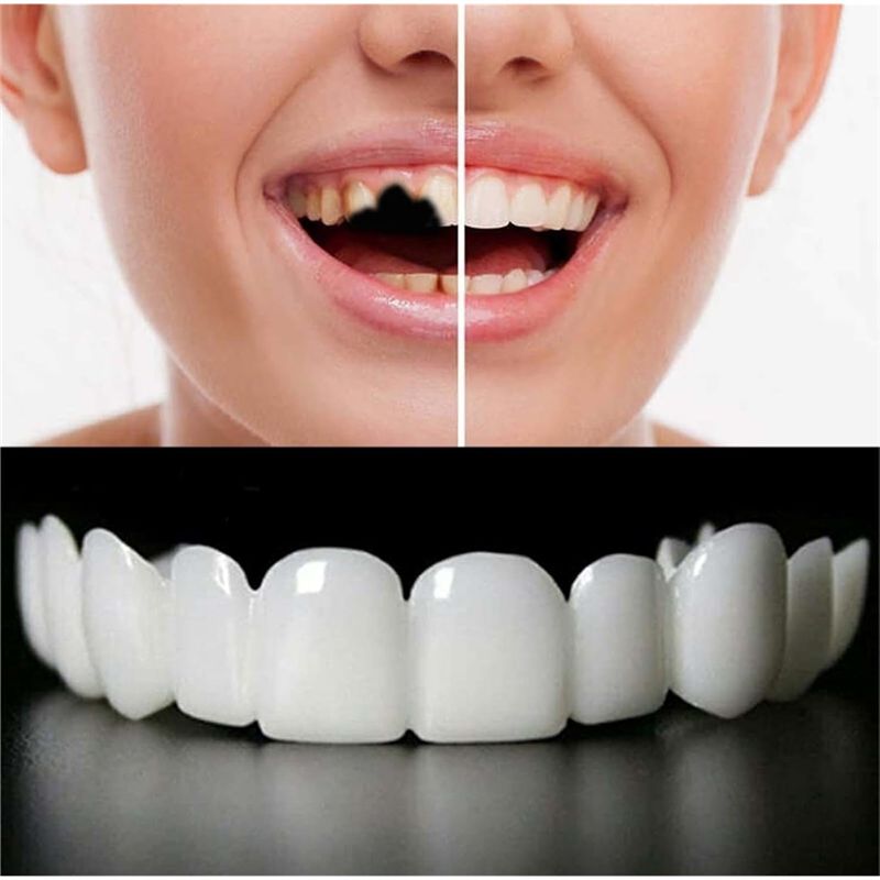 Veneer Gigi Palsu Sementara ya - Teeth Whitening Uneven ulasan dan harga