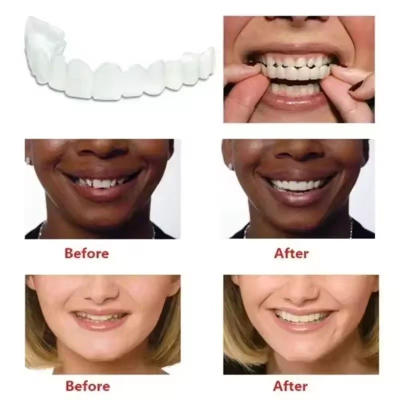 Veneer Gigi Palsu Sementara ya - Teeth Whitening Uneven ulasan dan harga